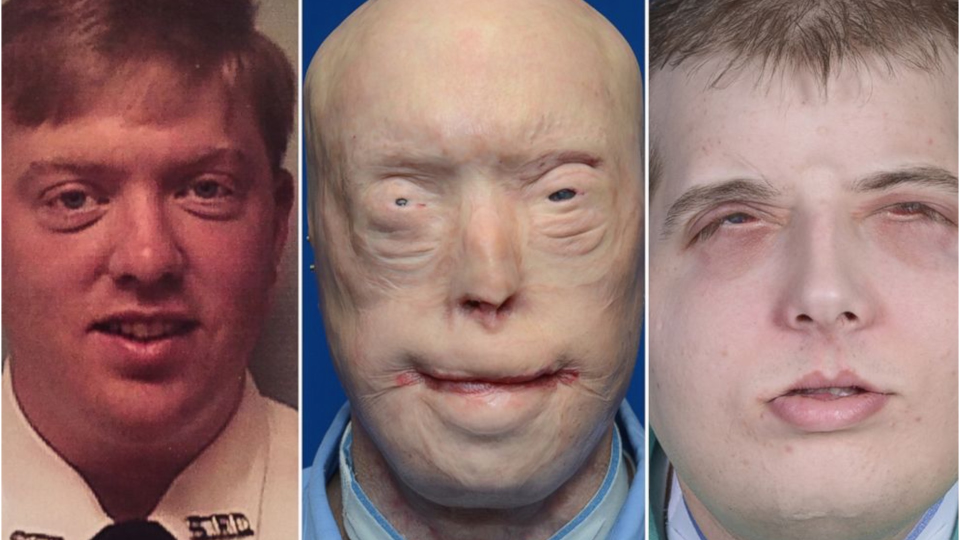 Face transplant recipient: 'I'm the same old Pat'