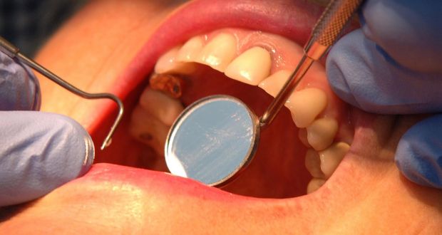 Use Of Mercury Based Dental Fillings To Be Phased Out - 