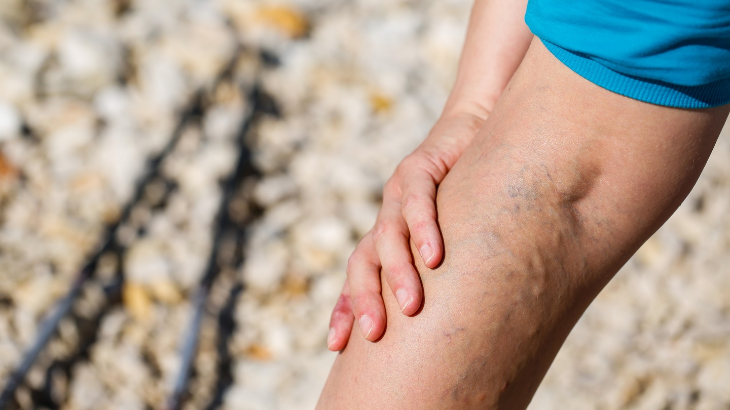 10 things you didn't know about varicose veins