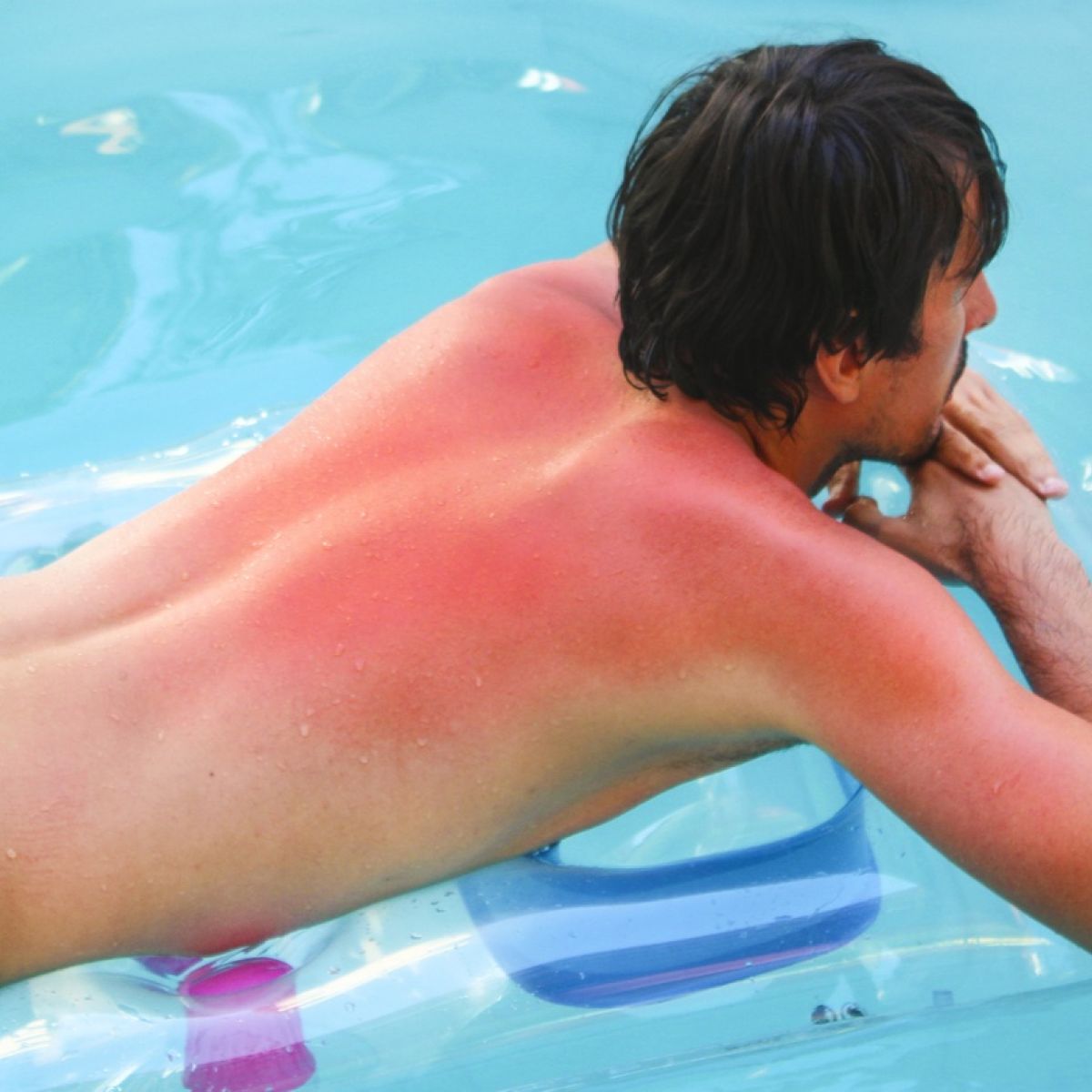 What To Do If You Have Sunburn