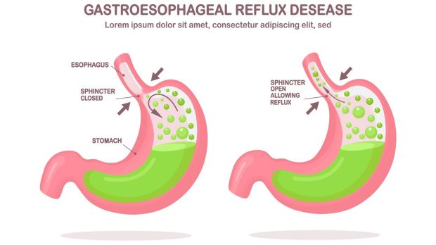 Acid moving up the oesophagus, as in gastroesophageal reflux disease, or GERD. Photograph: iStock