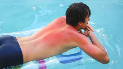 What to do if you have sunburn