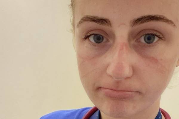 Doctor posts photo of bruised face from PPE in response to anti-mask campaign