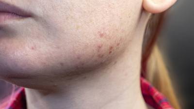 Acne: A serious problem that can appear in young children and even babies