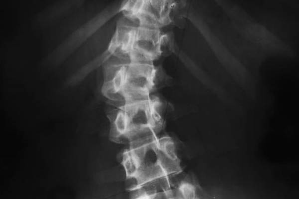 Crumlin hospital only provider of spinal rods at centre of recall