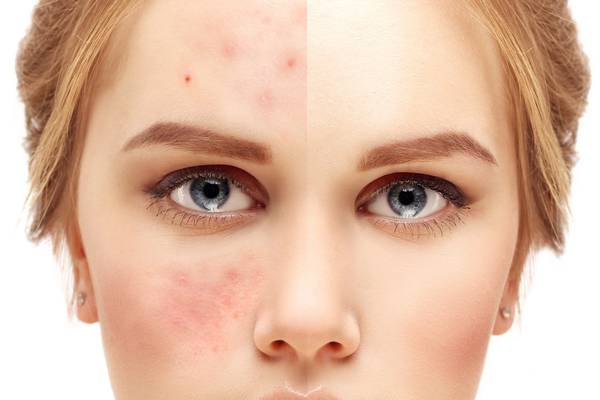 Red, flaking skin? The over the counter products that work