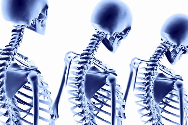 Fad diet ‘nonsense’ may cause osteoporosis in young people