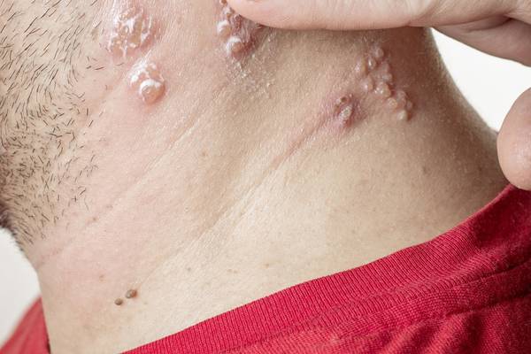 Shingles: Bring on the vaccine and free us from ‘hell’s fire’