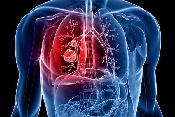 Many Irish people can not list any symptom of lung cancer