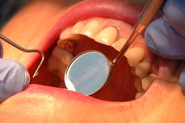 Dental extractions increase as State support for treatment falls