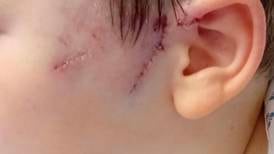 ‘The dog tore the face off him’: Boy left with 30 stitches after dog attack in Limerick last week