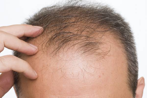Beating baldness: tips and ways to avoid hair loss