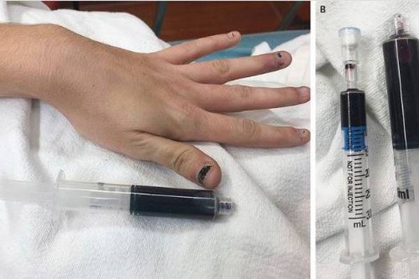 ‘I’m weak, and I’m blue’: US woman’s blood turns navy