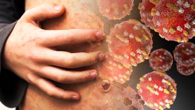 Nine further possible cases of measles reported in Ireland