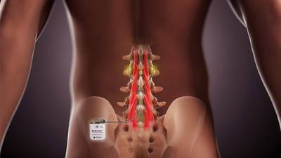 Back pain device group Mainstay Medical raises $108m