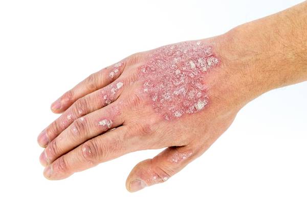 How to make life easier for Psoriasis sufferers