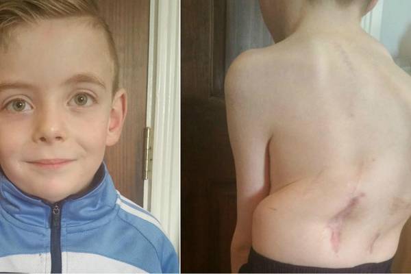 Six-year-old with scoliosis waiting for seventh operation