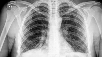 Risk of developing TB down to specific genes, new Irish study finds