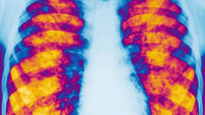 Cystic fibrosis drug could make disease a manageable condition