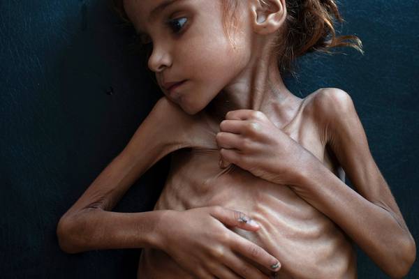 Yemen girl whose image drew attention to famine is dead