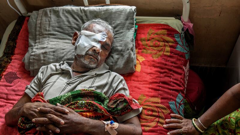 A mucormycosis patient at Ahmedabad Civil Hospital: Heavy use of steroids, a correlation with diabetes and unsanitary conditions at some hospitals have played a role. Photograph: Atul Loke/New York Times