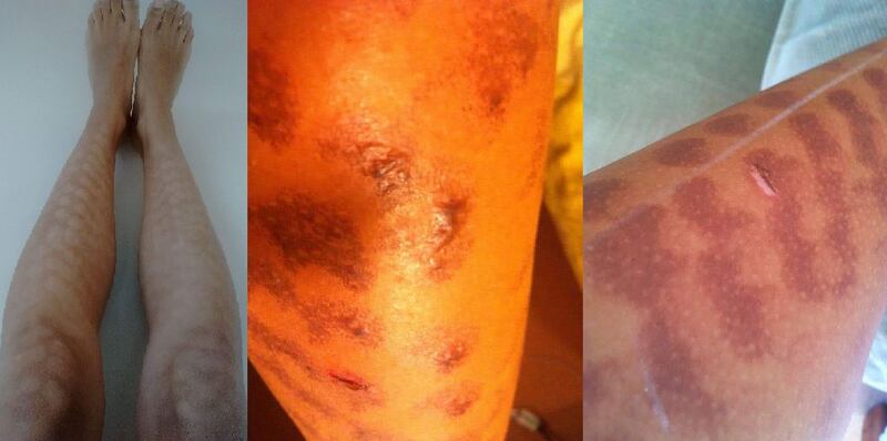 Images submitted to the High Court of injuries Naomi Kumar said she experienced due to the laser treatment.