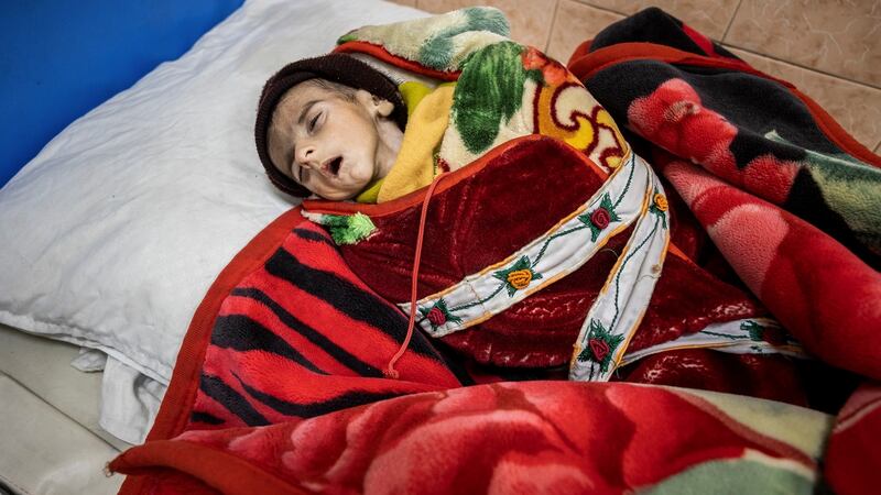 A malnourished child at the Indira Gandhi Children’s Hospital in Kabul. Photograph: Jim Huylebroek/New York Times