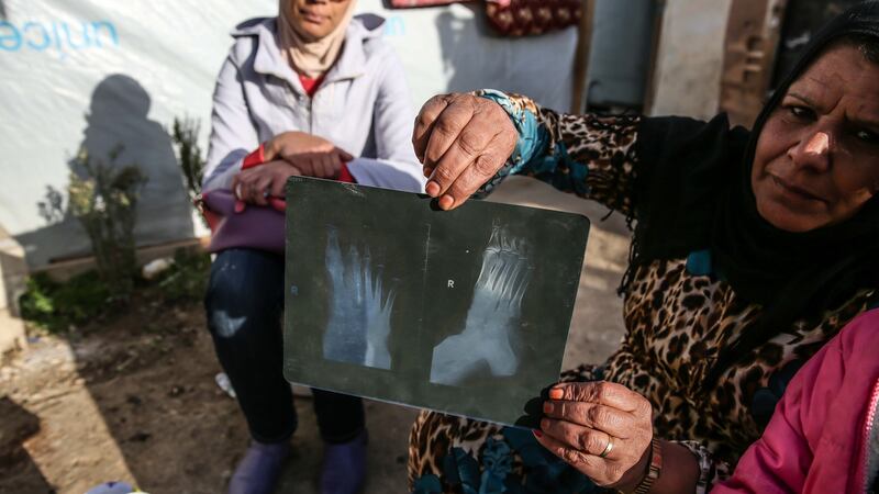 Finti Faiz Aljasim shows where shrapnel entered her foot when her home was hit by a shell. Photograph: Sally Hayden