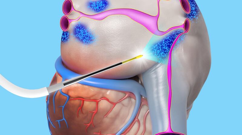 AtriAN Medical’s technology involves using a catheter to deliver short pulses of electrical energy into the clusters of neuronal cells in which the cardial arrhythmia originates.