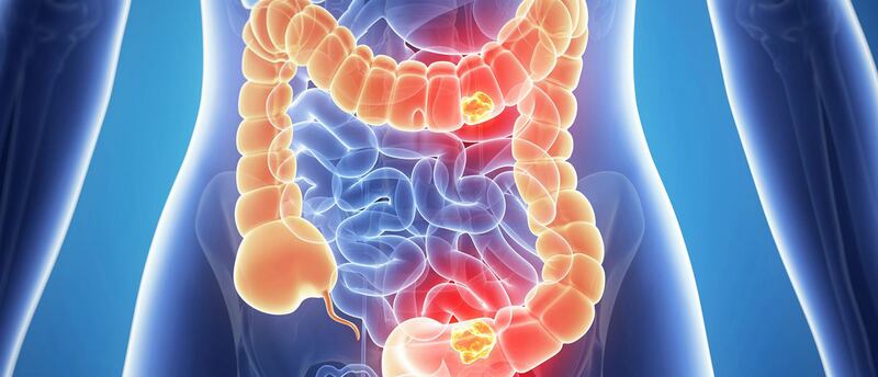 Initial symptoms of bowel cancer could be confused with more minor ailments such as IBS. Photograph: Queen's University Belfast/PA