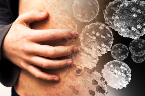 Public health alert issued to bus passengers and restaurant-goers after measles death