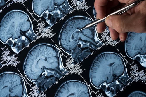 Irish scientists identify novel approach to preventing epileptic seizures