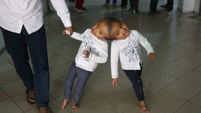 Conjoined twins Rabeya and Rukaiya, from Bangladesh, with their father Rafiqul Islam. The two-year-old girls are in Hungary for treatment, and are expected to be seperated in a series of surgeries to take place in Dhaka. Photograph: Rehman Asad/AFP/Getty Images