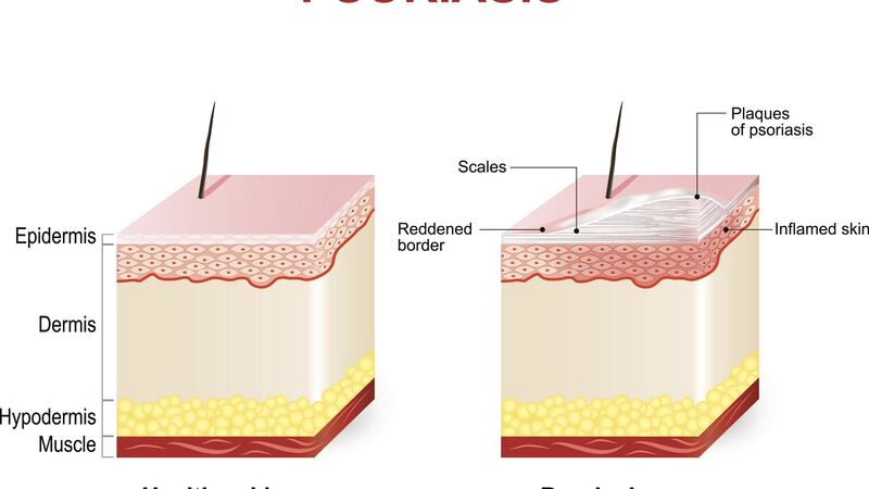 Symptoms of psoriasis. Normal skin and psoriasis. plaque psoriasis