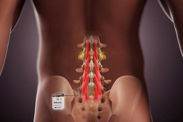Mainstay Medical sells its first ReActiv8 implant for back pain