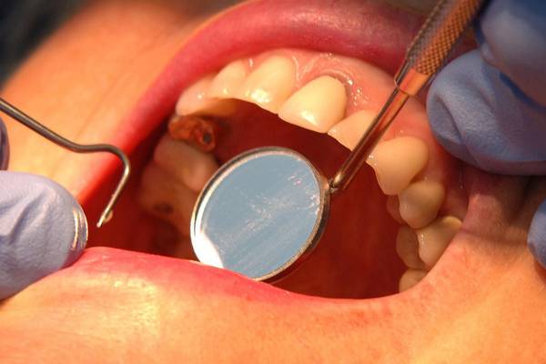 Woman refunded €350 after complicated tooth extraction