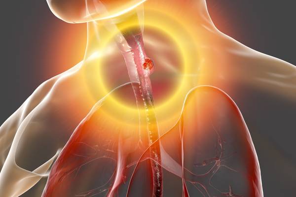 What to look out for: Symptoms of oesophageal cancer